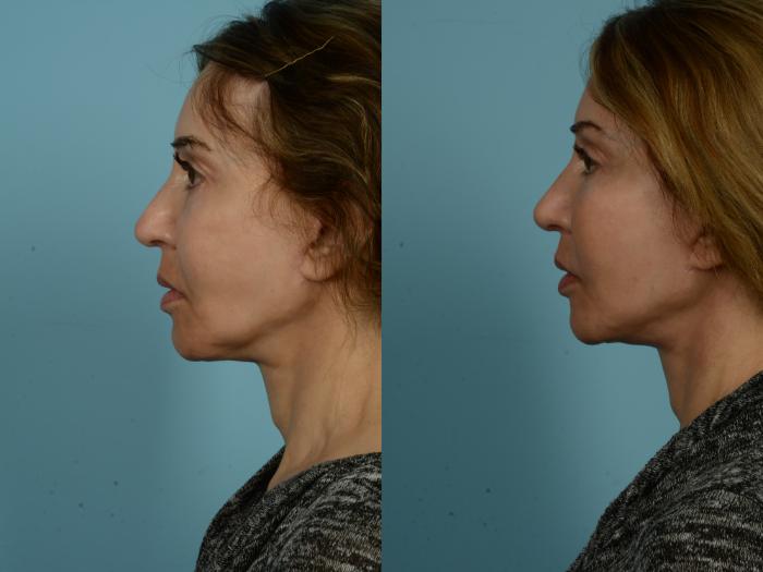 Before & After Facelift/Minilift by Dr. Sinno Case 906 Left Side View in Chicago, IL