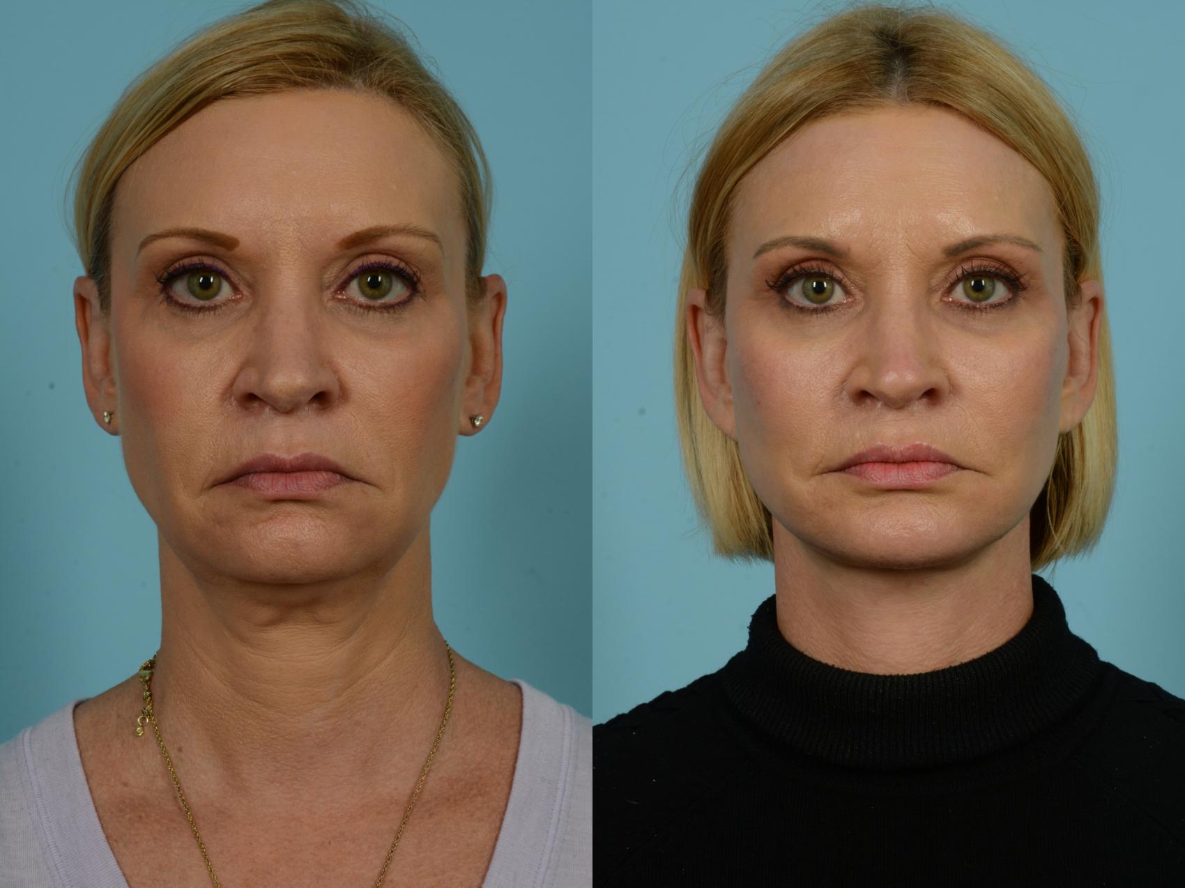 Before & After Dual Plane Facelift by Dr. Sinno Case 921 Front View in Chicago, IL