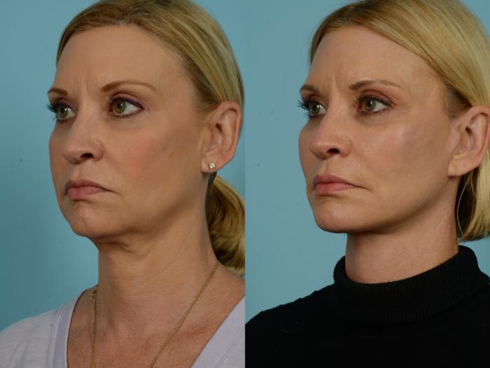 Before & After Facelift/Minilift by Dr. Sinno Case 921 Left Oblique View in Chicago, IL