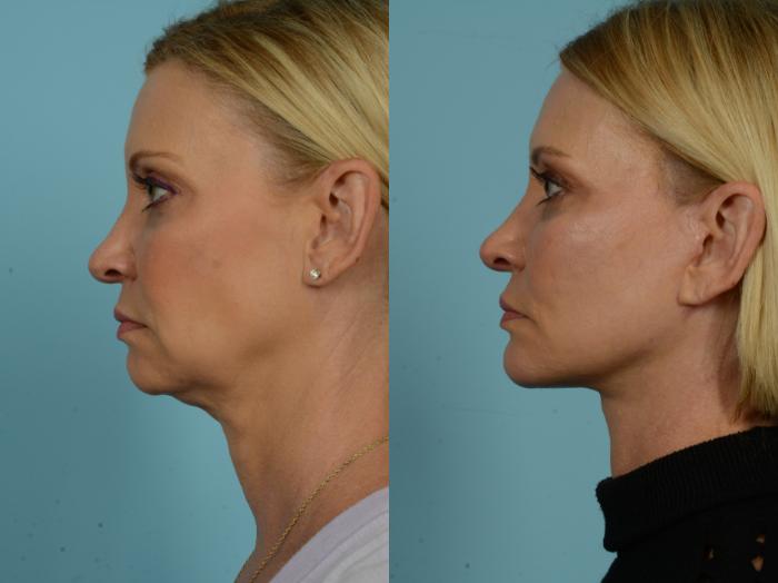 Before & After Neck Lift by Dr. Sinno Case 921 Left Side View in Chicago, IL