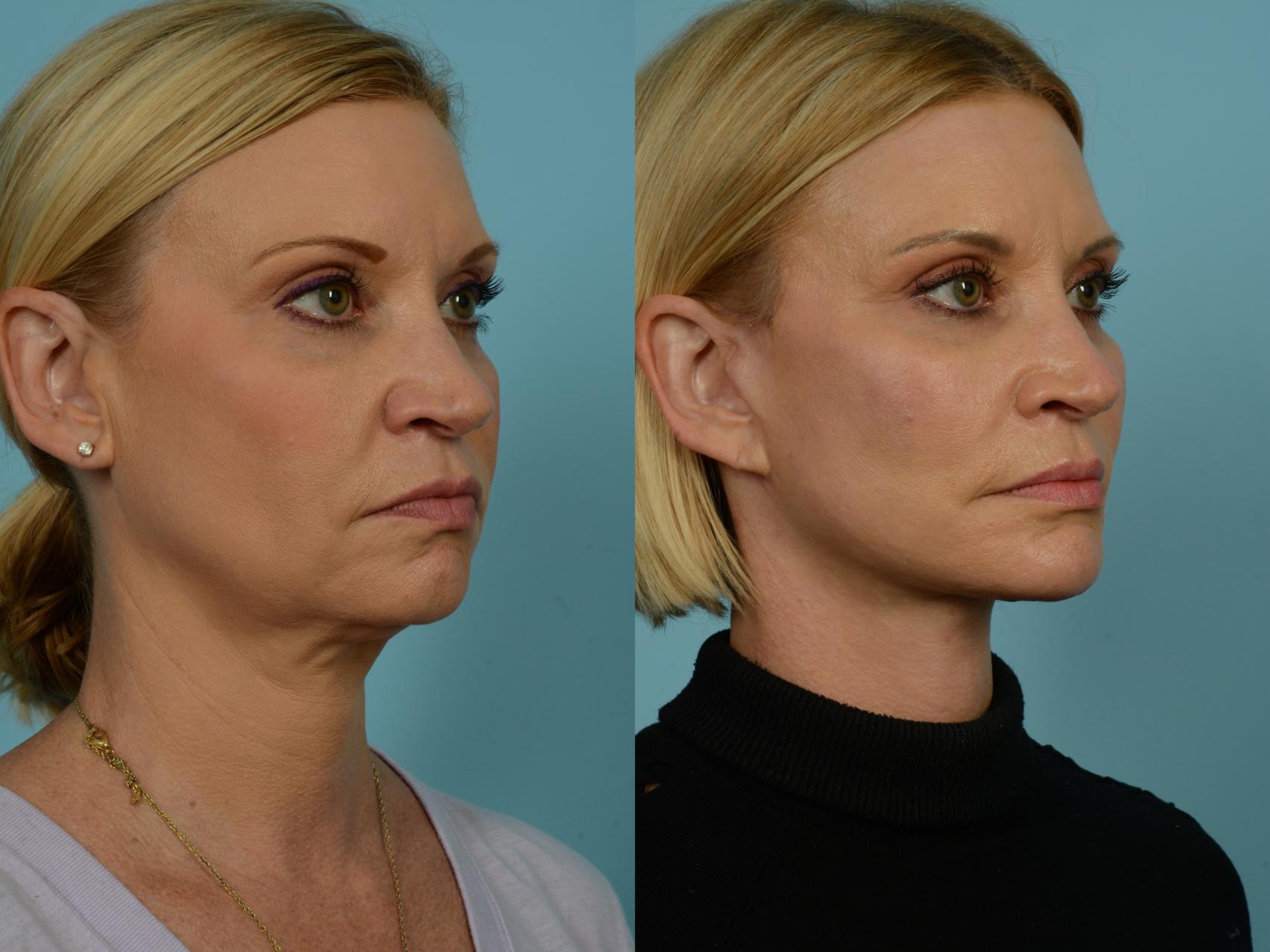 Before & After Dual Plane Facelift by Dr. Sinno Case 921 Right Oblique View in Chicago, IL