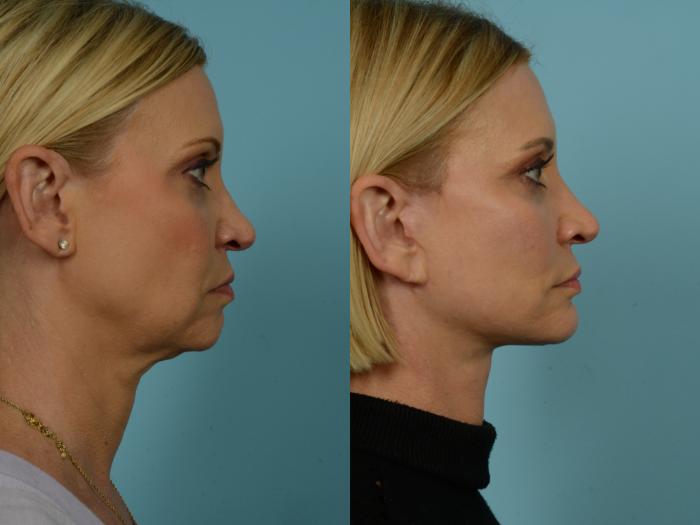 Before & After Neck Lift by Dr. Sinno Case 921 Right Side View in Chicago, IL