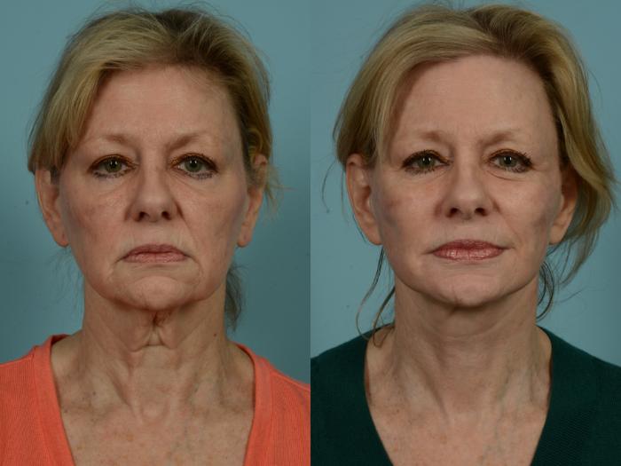 Before & After Neck Lift by Dr. Sinno Case 969 Front View in Chicago, IL