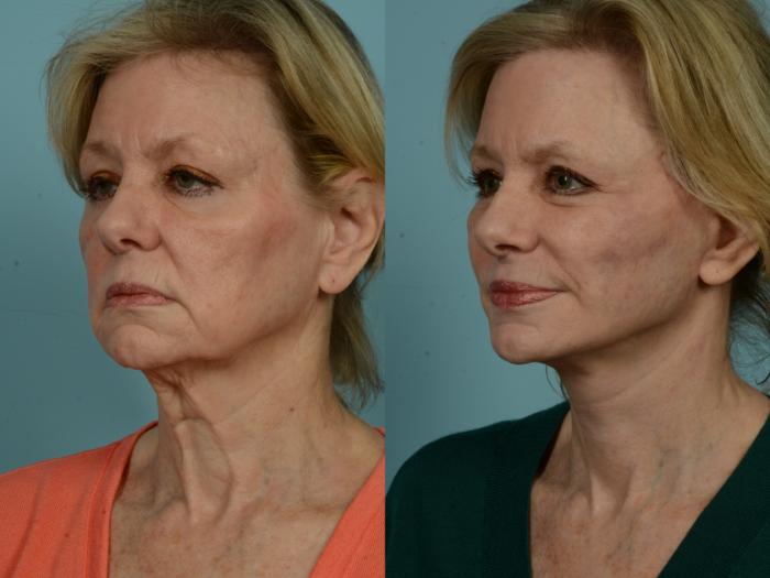 Before & After Midface Lift by Dr. Sinno Case 969 Left Oblique View in Chicago, IL