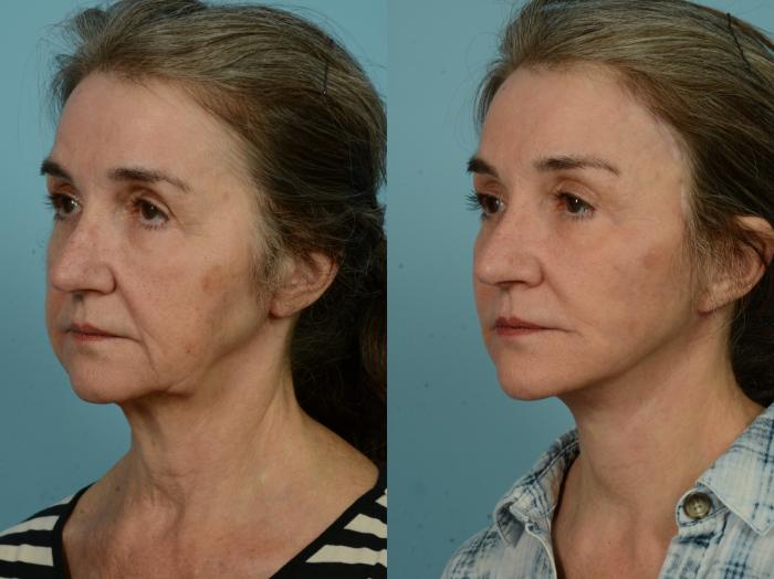 Before & After Neck Lift by Dr. Sinno Case 970 Left Oblique View in Chicago, IL