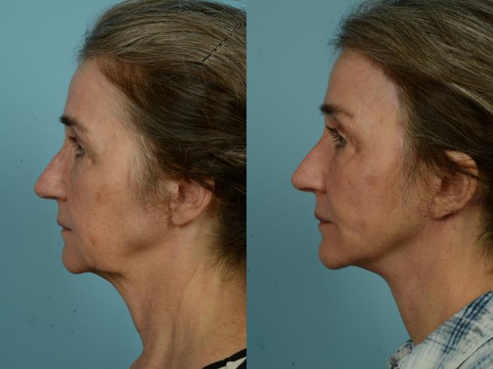 Before & After Facelift/Minilift by Dr. Sinno Case 970 Left Side View in Chicago, IL