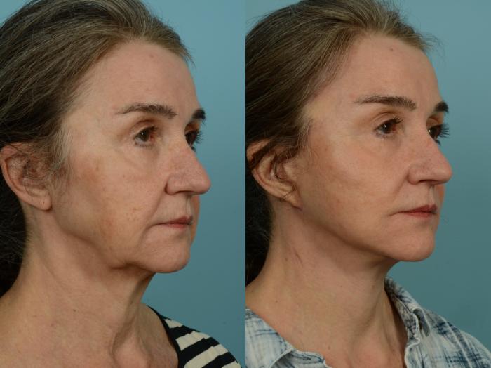 Before & After Midface Lift by Dr. Sinno Case 970 Right Oblique View in Chicago, IL