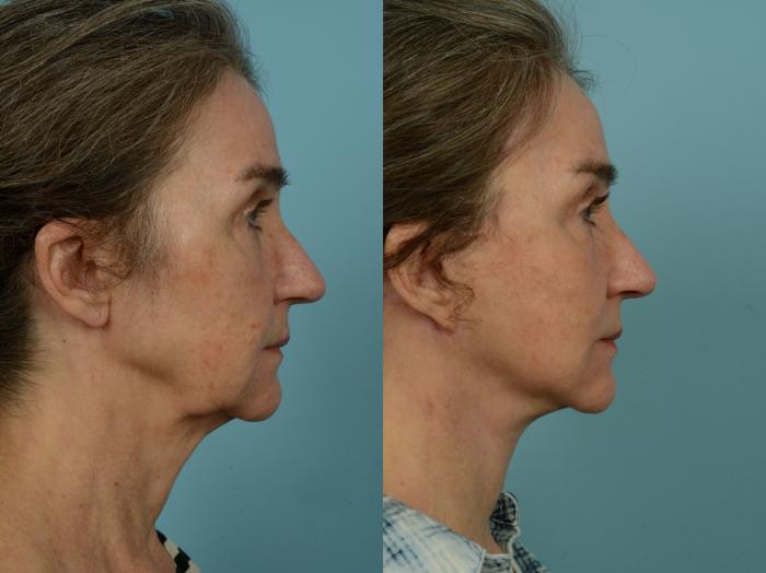 Before & After Neck Lift by Dr. Sinno Case 970 Right Side View in Chicago, IL