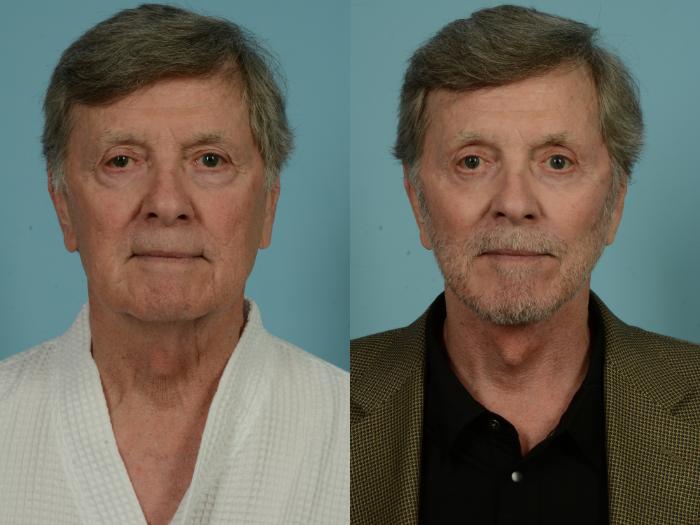 Before & After Facelift/Minilift by Dr. Sinno Case 983 Front View in Chicago, IL