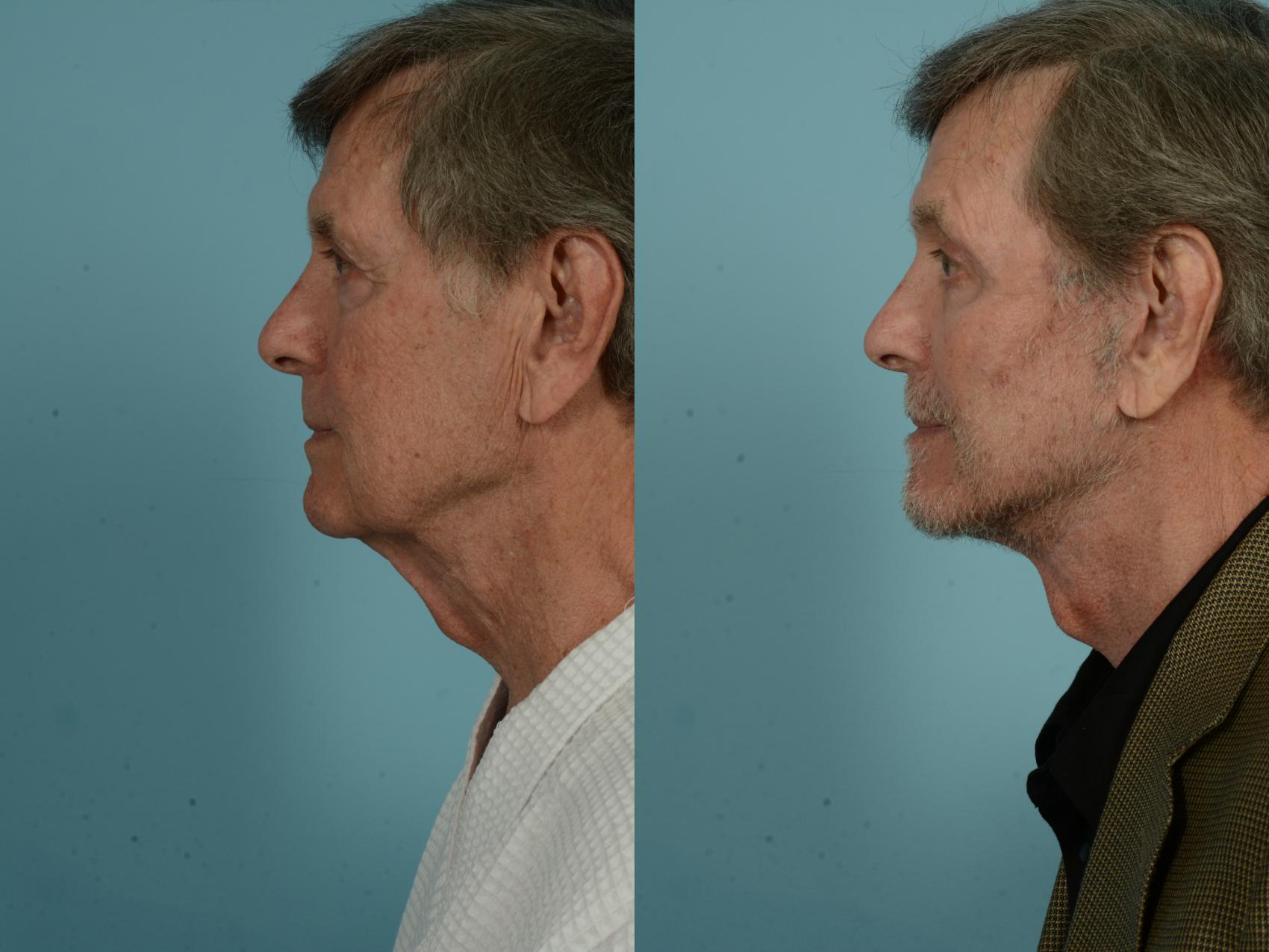 Before & After Facelift/Minilift by Dr. Sinno Case 983 Left Side View in Chicago, IL