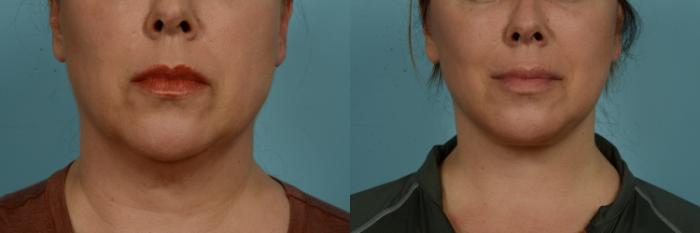 Before & After Fat Grafting by Dr. Mustoe Case 1004 Front View in Chicago, IL