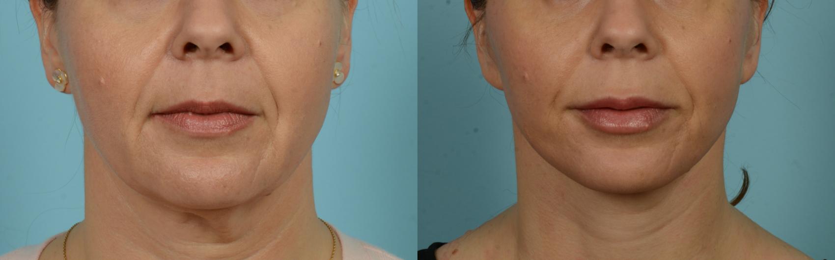 Before & After Fat Grafting by Dr. Mustoe Case 943 Mouth View in Chicago, IL