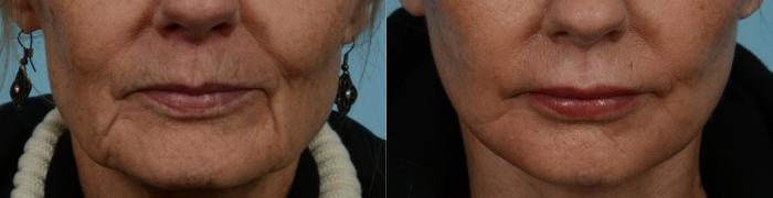 Before & After Fat Grafting by Dr. Mustoe Case 977 Front View in Chicago, IL