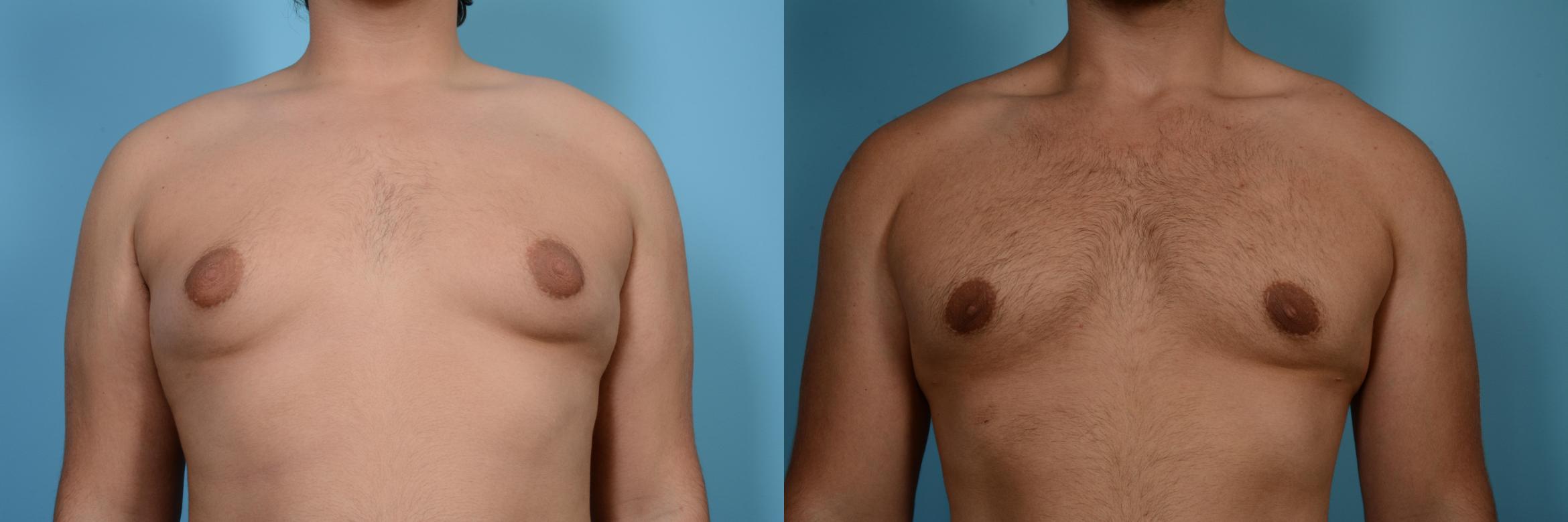 Before & After Male Breast Reduction (Gynecomastia) Case 558 View #1 View in Chicago, IL