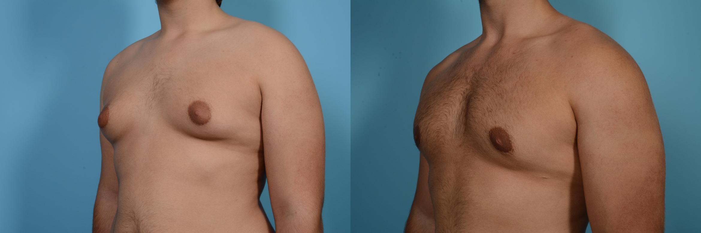 Before & After Male Breast Reduction (Gynecomastia) Case 558 View #2 View in Chicago, IL
