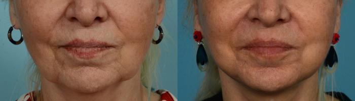 Before & After Laser Resurfacing by Dr. Mustoe Case 1048 Front View in Chicago, IL
