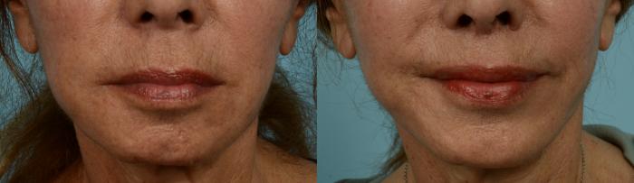 Before & After Lip lift  Case 1088 Front View in Chicago, IL