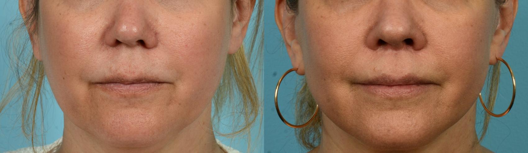 Before & After Lip Lift  Case 1129 Front View in Chicago, IL