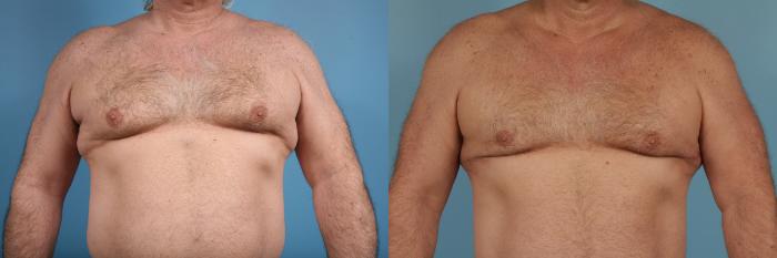 Before & After Male Breast Reduction (Gynecomastia) Case 174 View #1 View in Chicago, IL