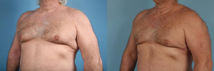 Before & After Male Breast Reduction (Gynecomastia) Case 174 View #2 View in Chicago, IL