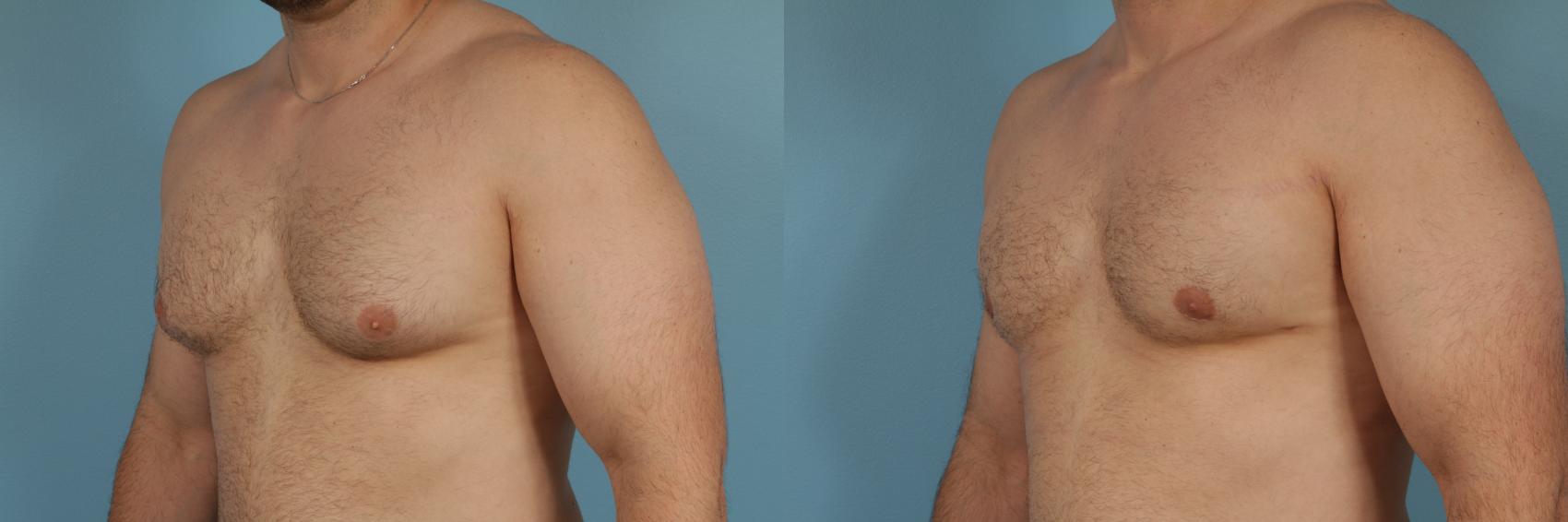 Before & After Male Breast Reduction (Gynecomastia) Case 209 View #1 View in Chicago, IL