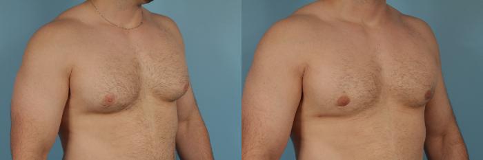Before & After Male Breast Reduction (Gynecomastia) Case 209 View #2 View in Chicago, IL