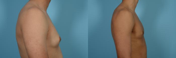 Before & After Male Breast Reduction (Gynecomastia) Case 517 View #3 View in Chicago, IL