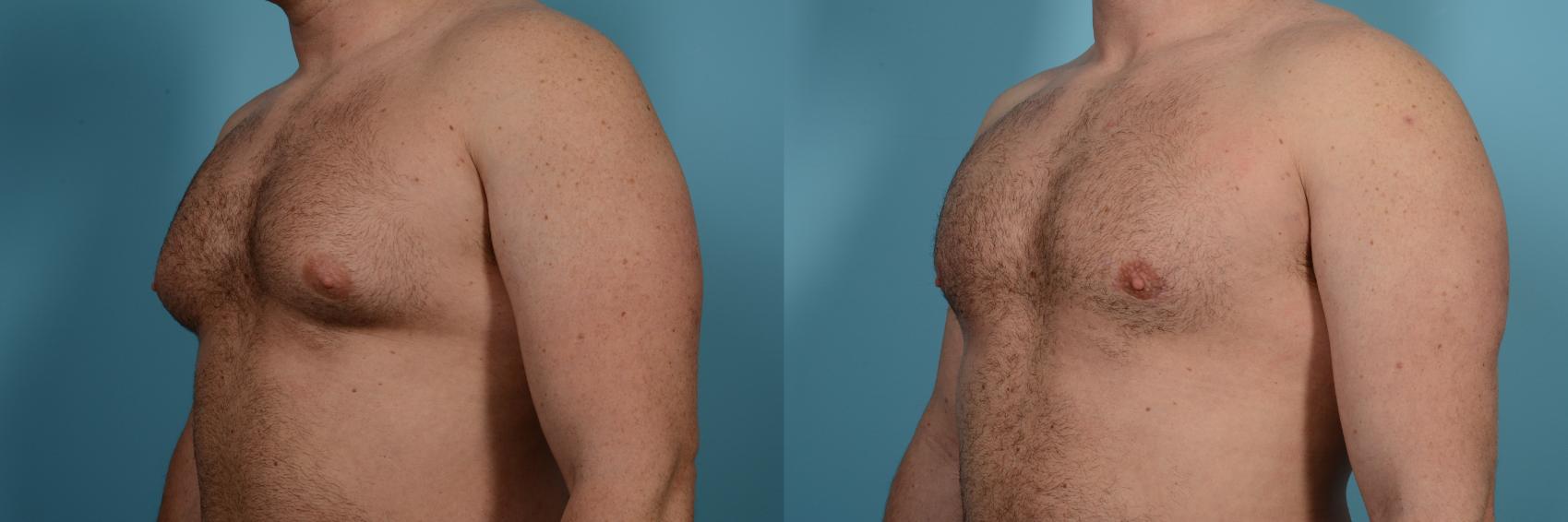 Dr. Sinno Gynecomastia Surgery in Chicago, Illinois