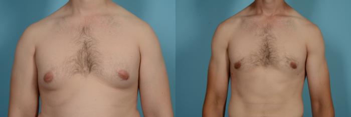 Before & After Male Breast Reduction (Gynecomastia) Case 630 Front View in Chicago, IL