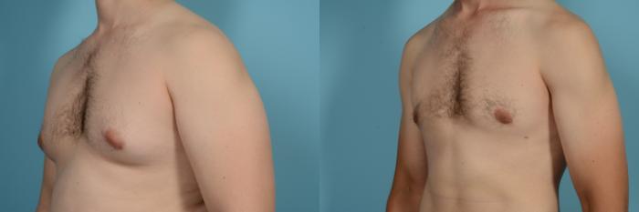 Before & After Male Breast Reduction (Gynecomastia) Case 630 Left Oblique View in Chicago, IL