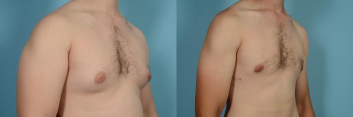 Before & After Male Breast Reduction (Gynecomastia) Case 630 Right Oblique View in Chicago, IL