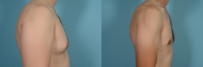 Before & After Male Breast Reduction (Gynecomastia) Case 630 Right Side View in Chicago, IL