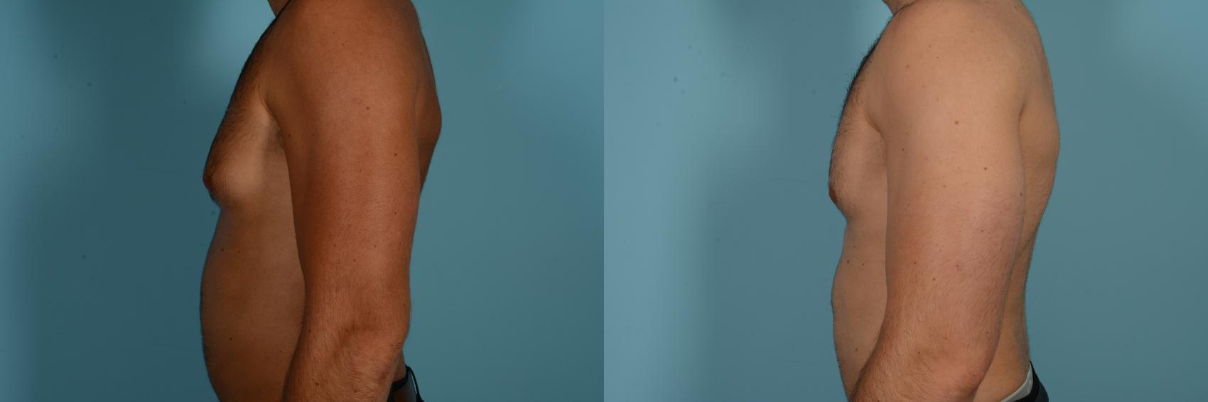 Dr. Sinno Gynecomastia Surgery in Chicago, Illinois
