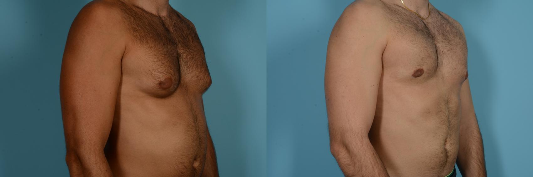 Dr. Sinno Gynecomastia Surgery in Chicago, Illinois