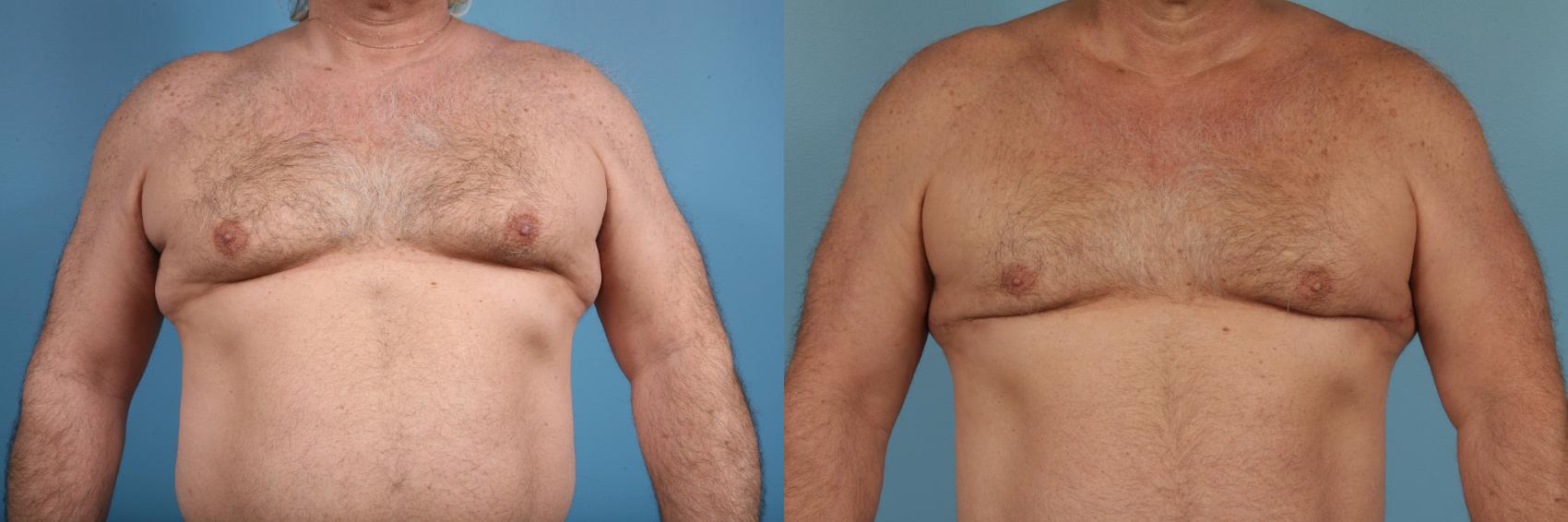 Before & After Male Breast Reduction (Gynecomastia) by Dr. Mustoe Case 174 View #1 View in Chicago, IL