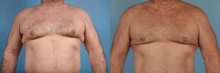Before & After Male Breast Reduction (Gynecomastia) by Dr. Mustoe Case 174 View #1 View in Chicago, IL