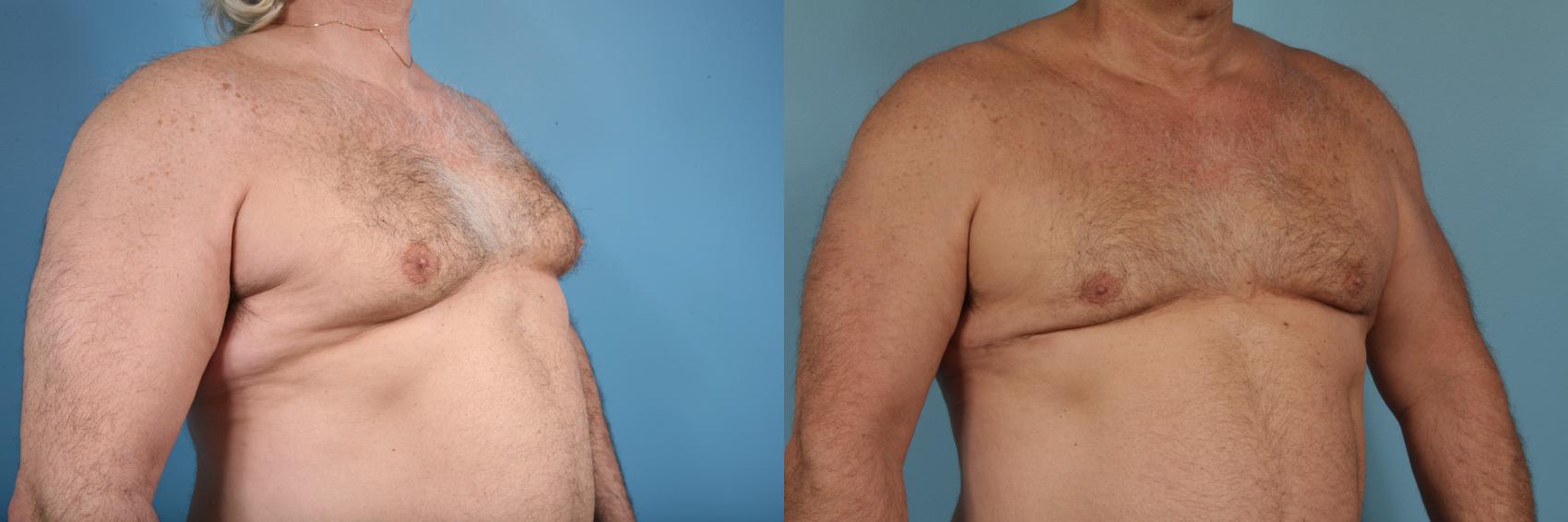 Before & After Male Breast Reduction (Gynecomastia) by Dr. Mustoe Case 174 View #3 View in Chicago, IL