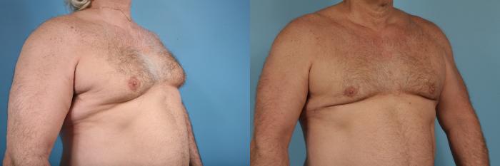 Before & After Male Breast Reduction (Gynecomastia) by Dr. Mustoe Case 174 View #3 View in Chicago, IL