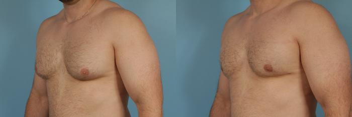 Before & After Male Breast Reduction (Gynecomastia) by Dr. Mustoe Case 209 View #1 View in Chicago, IL