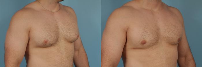 Before & After Male Breast Reduction (Gynecomastia) by Dr. Mustoe Case 209 View #2 View in Chicago, IL