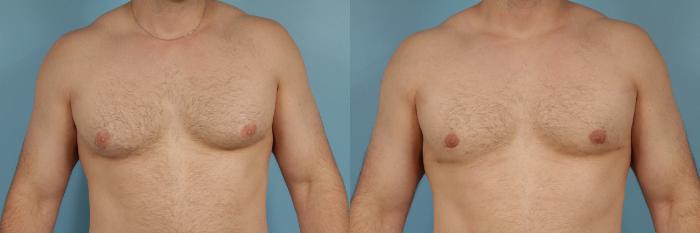 Before & After Male Breast Reduction (Gynecomastia) by Dr. Mustoe Case 209 View #3 View in Chicago, IL
