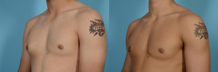 Before & After Male Breast Reduction (Gynecomastia) by Dr. Mustoe Case 517 View #2 View in Chicago, IL