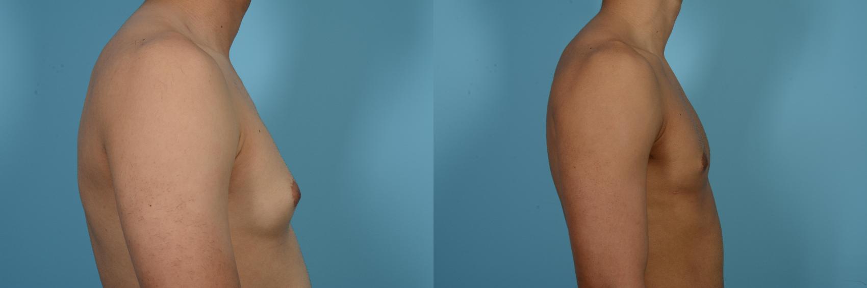 Before & After Male Breast Reduction (Gynecomastia) by Dr. Mustoe Case 517 View #3 View in Chicago, IL