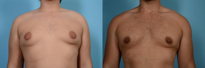 Before & After Male Breast Reduction (Gynecomastia) by Dr. Mustoe Case 558 View #1 View in Chicago, IL