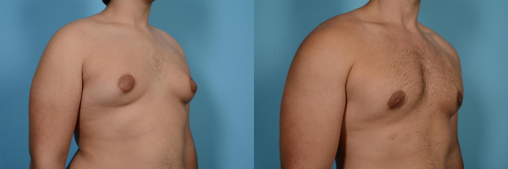 Before & After Male Breast Reduction (Gynecomastia) by Dr. Mustoe Case 558 View #3 View in Chicago, IL