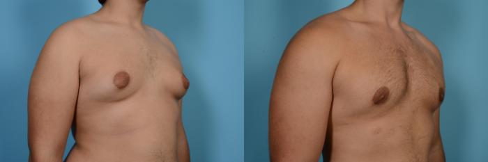 Before & After Male Breast Reduction (Gynecomastia) by Dr. Mustoe Case 558 View #3 View in Chicago, IL