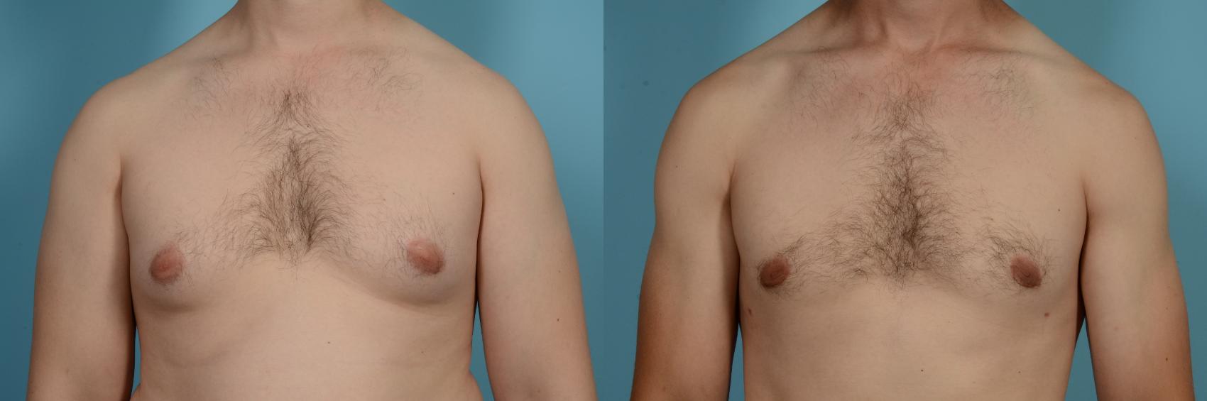 Before & After Male Breast Reduction (Gynecomastia) by Dr. Mustoe Case 630 Front View in Chicago, IL