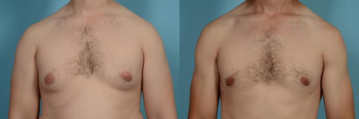 Before & After Male Breast Reduction (Gynecomastia) by Dr. Mustoe Case 630 Front View in Chicago, IL