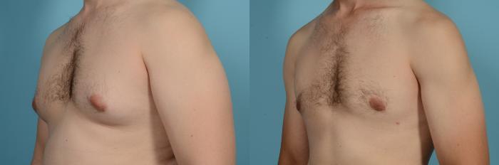 Before & After Male Breast Reduction (Gynecomastia) by Dr. Mustoe Case 630 Left Oblique View in Chicago, IL