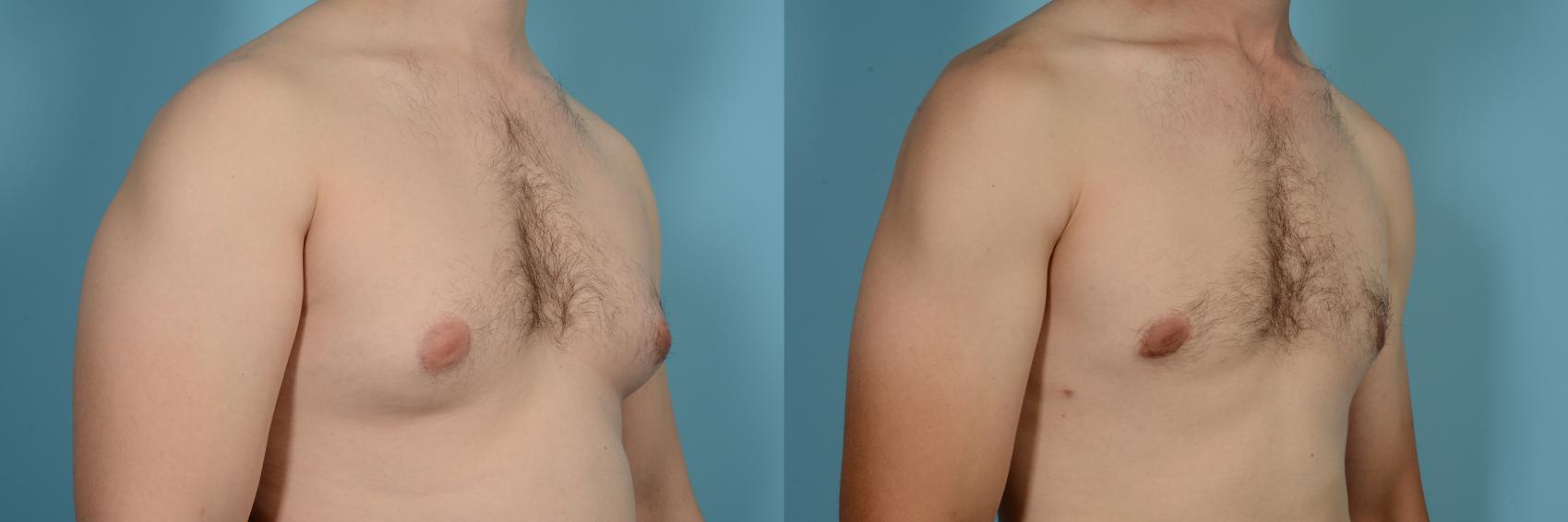 Before & After Male Breast Reduction (Gynecomastia) by Dr. Mustoe Case 630 Right Oblique View in Chicago, IL